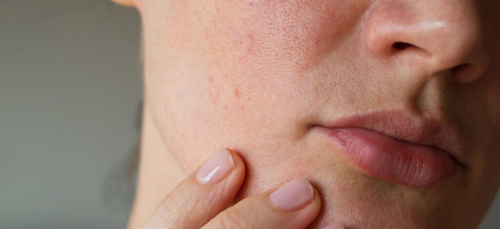huidirritatie door mondmasker